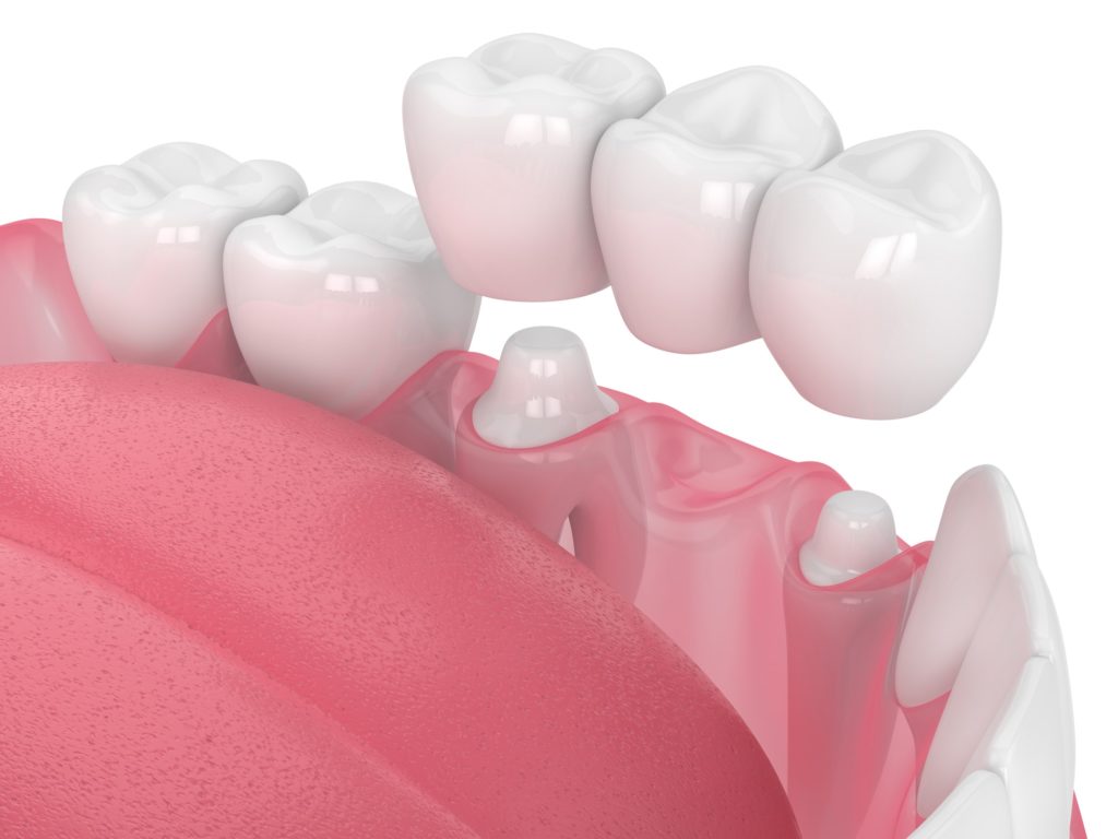 Illustration of a dental bridge being placed in a bottom row of teeth