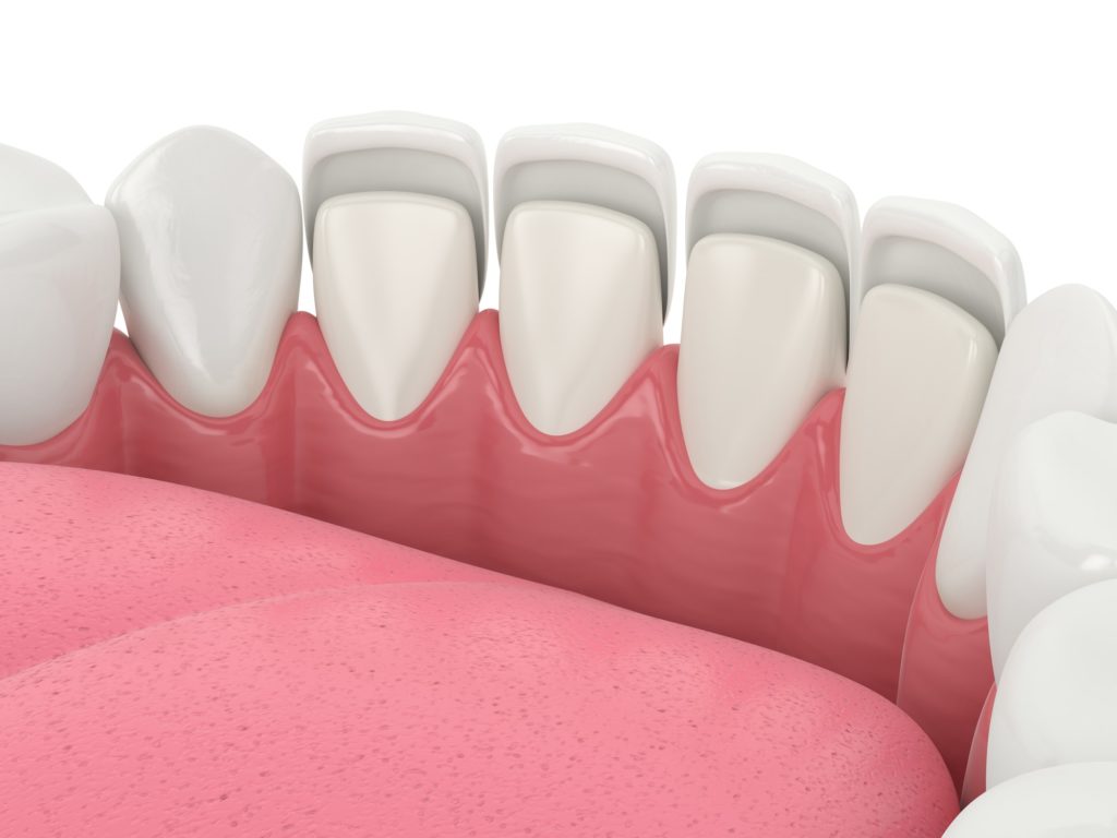 Illustration showing dental veneers being placed on a bottom row of teeth