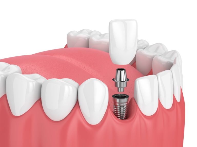 Illustration of a bottom row of teeth with a dental implant being installed
