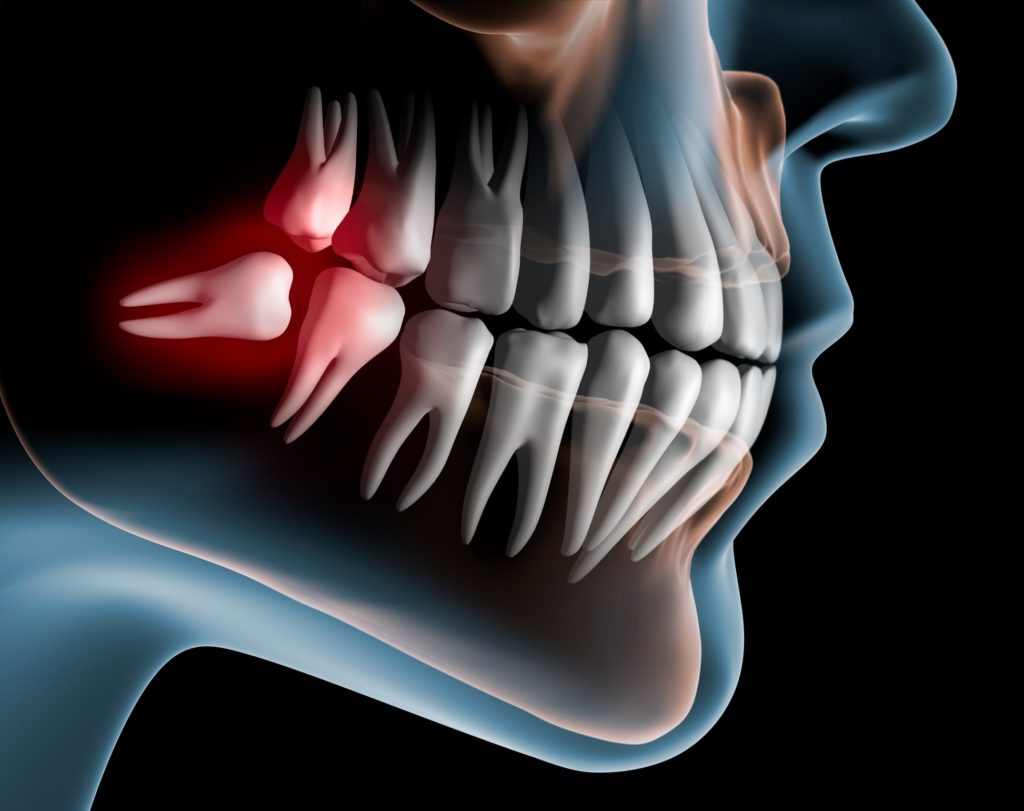 Illustration of a dental x-ray showing a crooked wisdom tooth