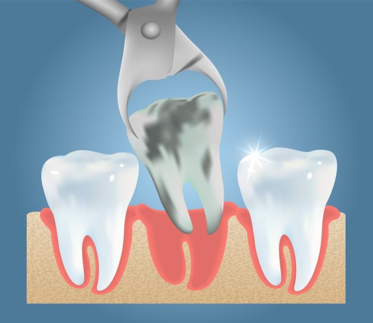 Illustration of a bad tooth being pulled