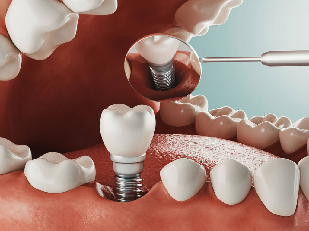 Illustration of a dental implant being examined in the gum line of a mouth