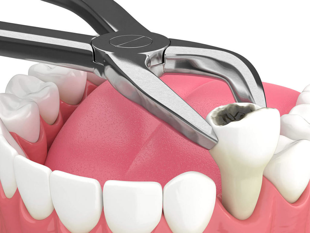 Tooth Extractions - The Dentist of Siouxland - Restorative Dental Care