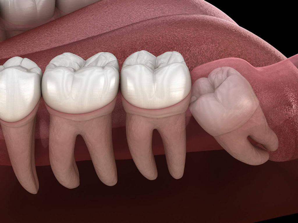 Illustration of teeth in a mouth showing an impacted wisdom tooth that needs removed