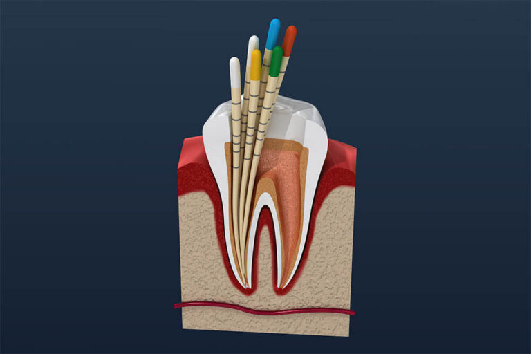 Illustration of a dental root canal procedure showing the interior of a tooth with multiple endodontic files inserted into the root canals for cleaning and shaping.