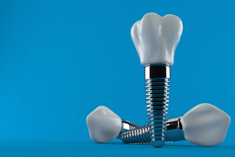 Illustration of three dental implants with tooth crowns on a blue background, showing the screw and abutment components.