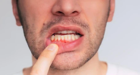 Gum disease blog by The Dentist of Siouxland.