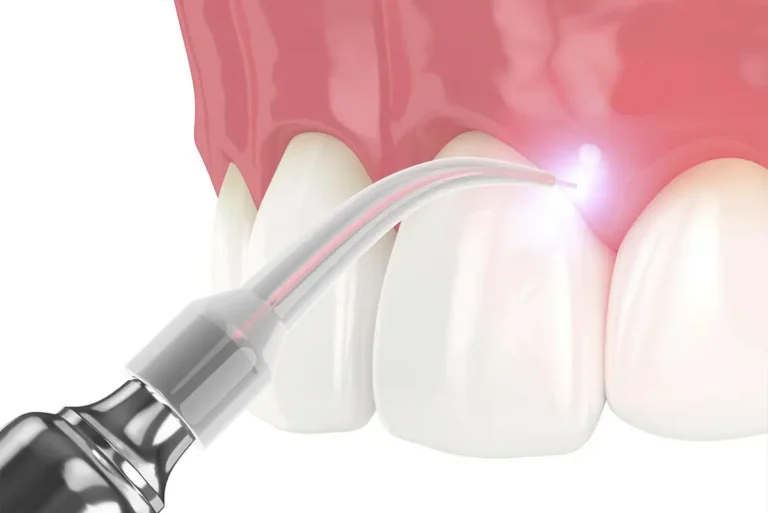 Soft tissue laser at The Dentist of Siouxland in Sioux City, IA and Elk Point, SD